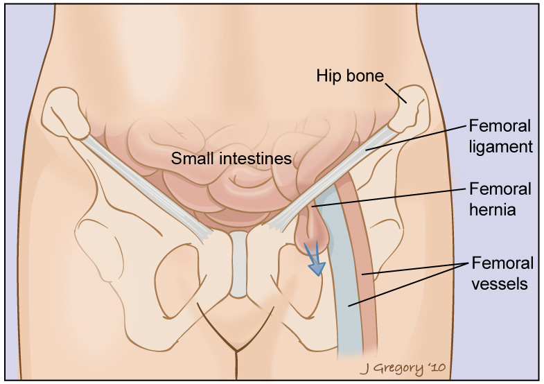Femoral Hernia - G & L Surgical Clinic
